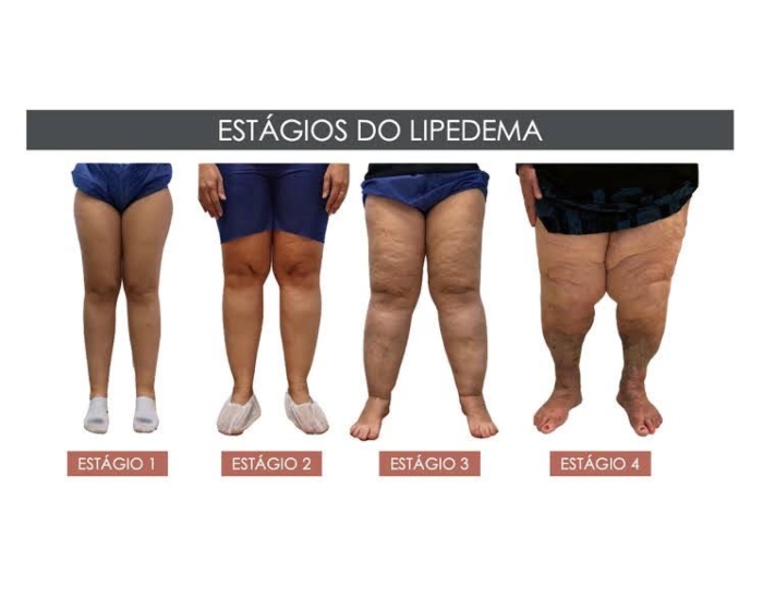 Doença da moda: por que estão falando tanto sobre o lipedema